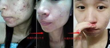 陈年粉刺视频,视频解析与护理攻略